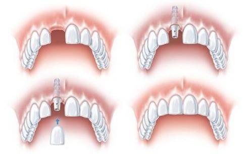 Các phương án trồng răng cửa cố định