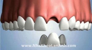 Hình: Cầu răng dán được mô phỏng trên máy vi tính. Bác sĩ chỉ cần mài một lớp mỏng của 2 răng bên cạnh để mang răng bị mất.