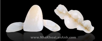 Hình: Cầu răng dán được tiện nguyên khối từ thỏi sứ EmaxCAD của Ivoclar Vivadent.