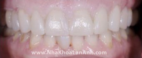 Hình: Dựa vào mẫu răng sáp, bác sĩ sẽ làm răng tạm cho bệnh nhân. Răng tạm có màu vàng (màu răng bình thường) hoặc màu trắng sáng (dành cho răng tẩy trắng hoặc làm toàn hàm), giúp bệnh nhân hình dung được 