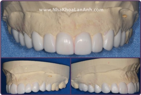 Hình: Trước khi mài răng, bác sĩ và kỹ thuật viên sẽ làm mô hình răng bằng sáp trên mẫu hàm bệnh nhân để bệnh nhân tham khảo.