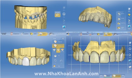 Hình: Răng sứ được mô phỏng trên máy vi tính theo răng tạm của bệnh nhân.