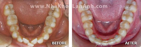 Hình: Khi bệnh nhân có nhu cầu, bác sĩ sẽ làm răng tạm khi sử dụng hệ thống Invisalign.
