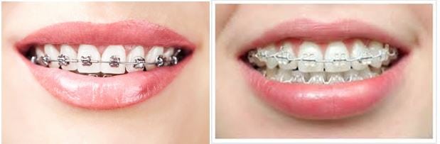 hinh-anh-nieng-rang-bang-khay-invisalign-3