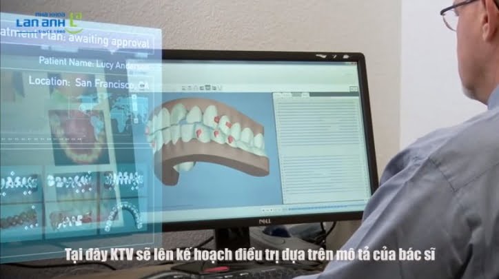 Chỉnh nha không mắc cài - chỉnh nha Invisalign 