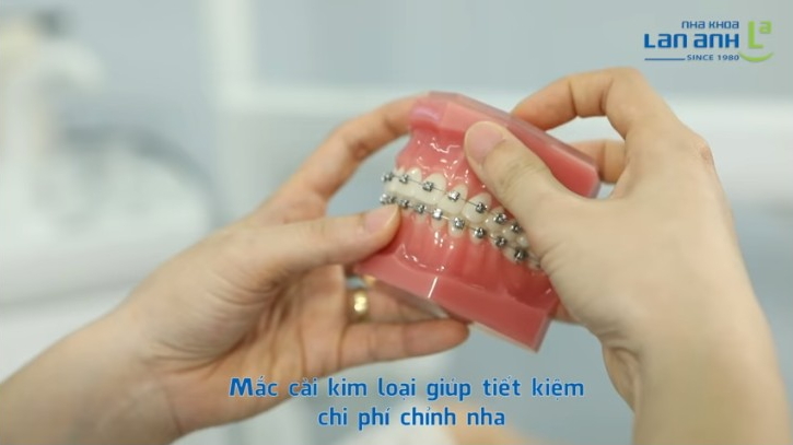 Chỉnh nha - Niềng răng tại Nha Khoa Lan Anh