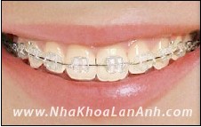 Các hệ thống mắc cài sử dụng trong chỉnh nha