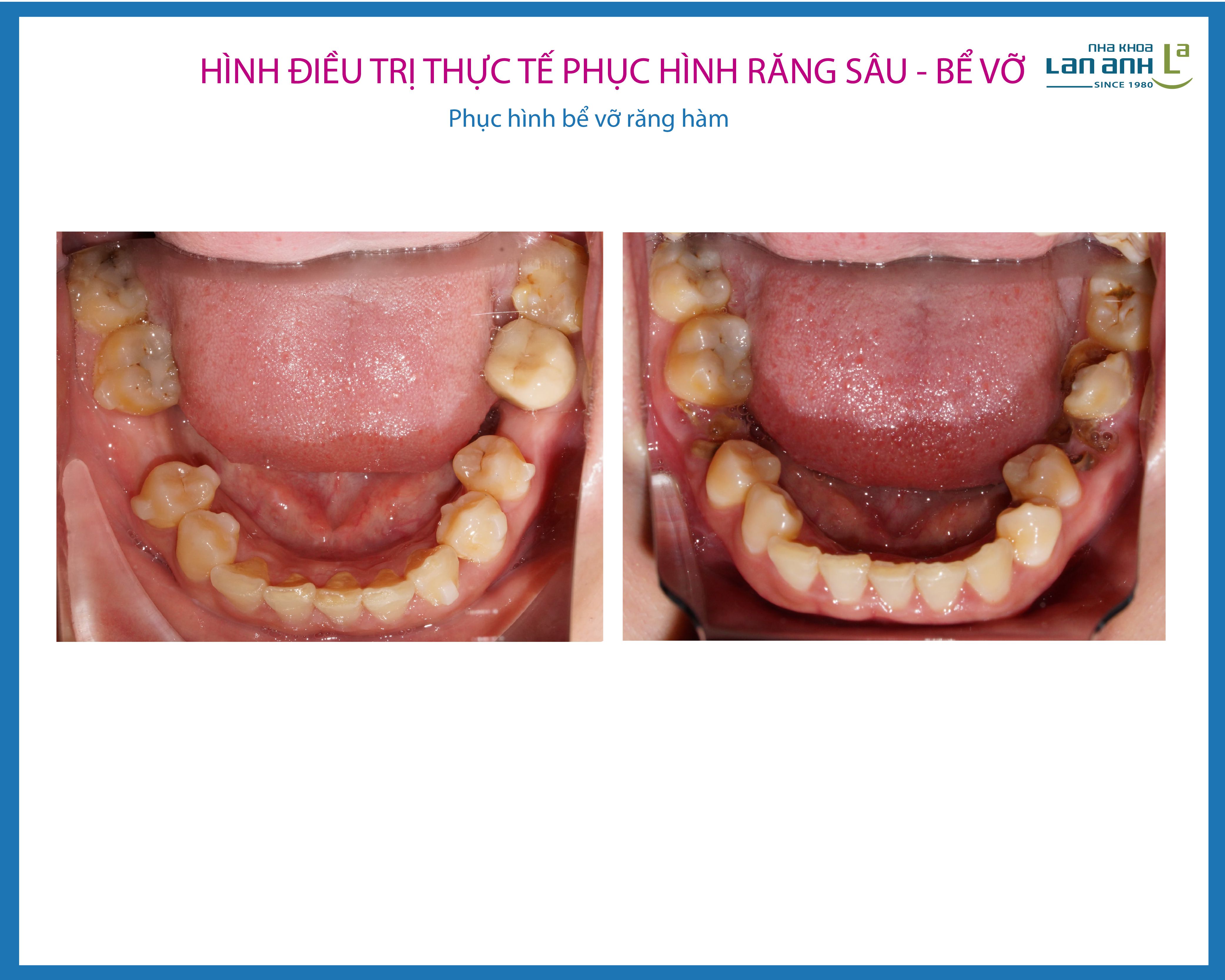 Phục hình răng sâu, bể, vỡ