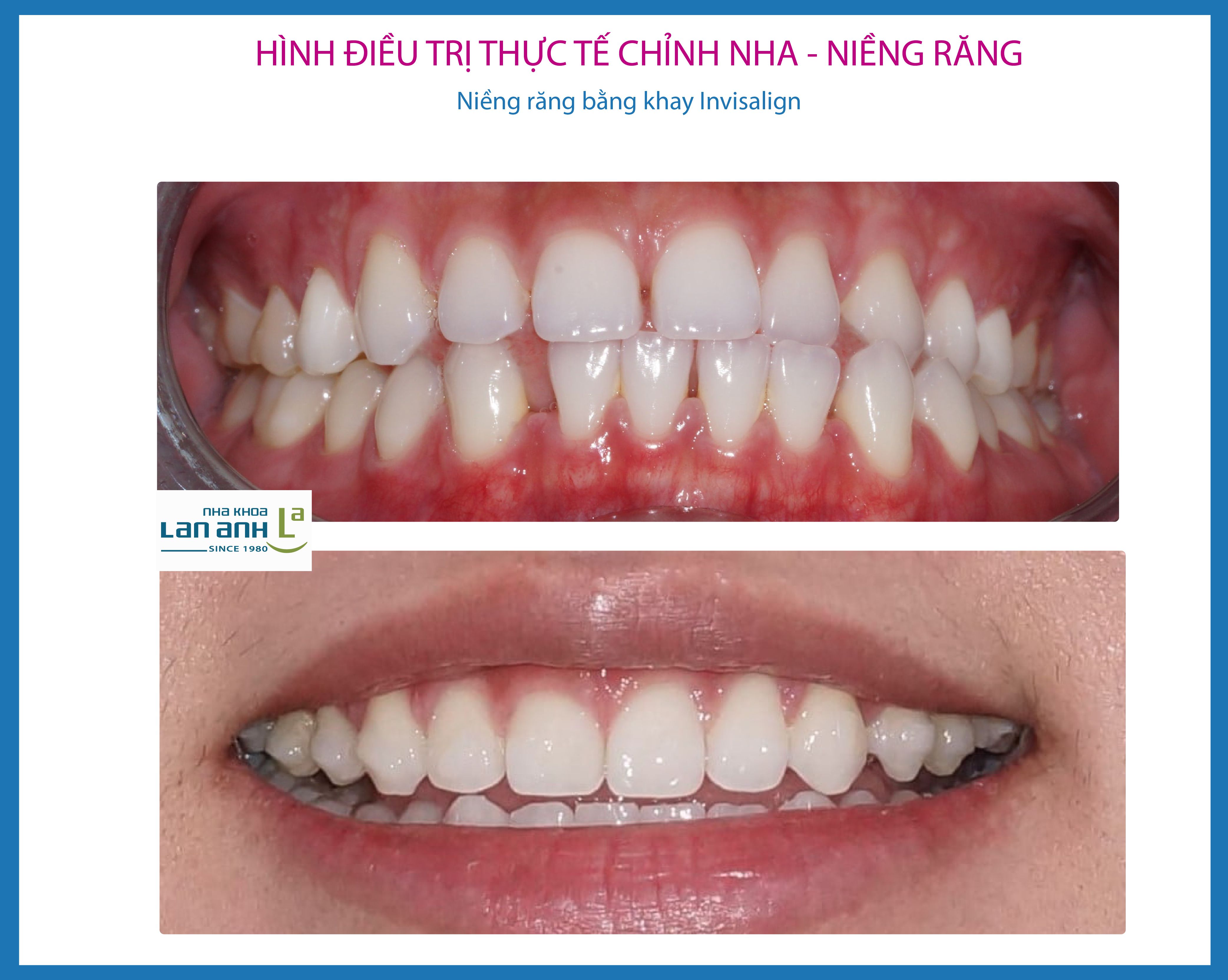 Chỉnh nha, niềng răng