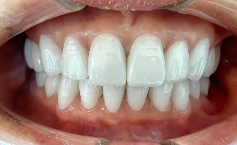 Răng sứ có độ bền bao lâu là hợp lý