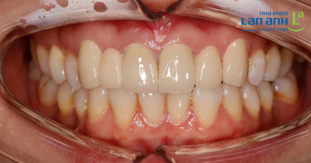Răng sứ có đổi màu sau một thời gian dài sử dụng không?