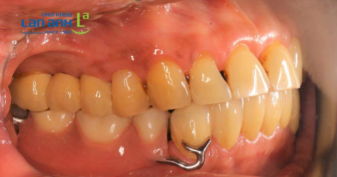 Ưu điểm của trồng răng bằng hàm tháo lắp