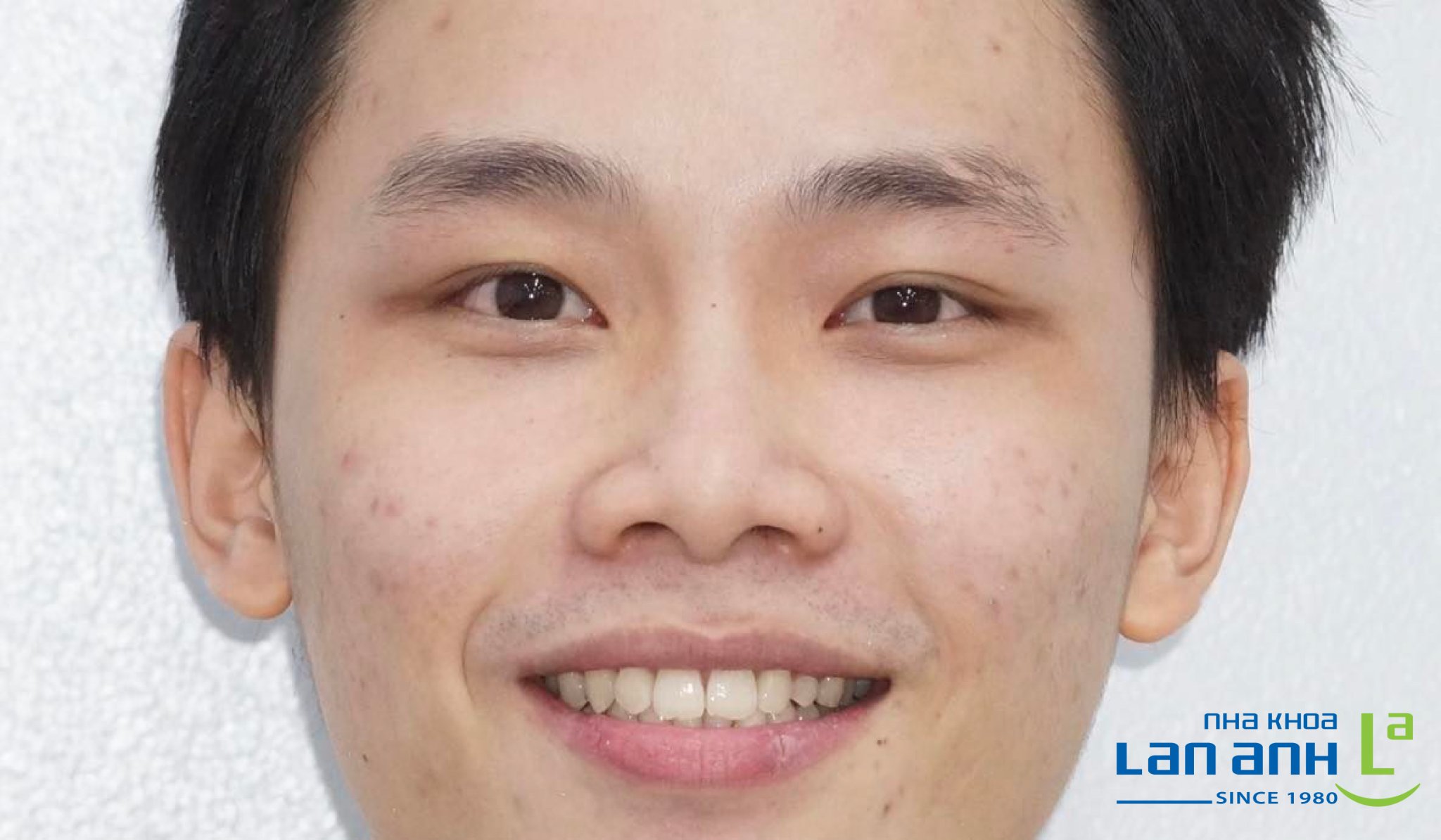 Niềng răng Invisalign có đạt kết quả tốt không?