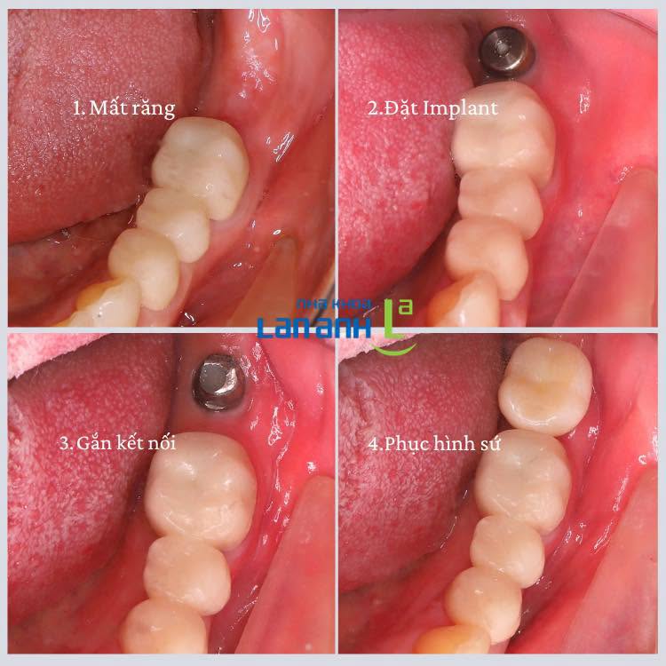 Nobel TiUltra kết hợp răng sứ Cercon - Giải pháp phục hồi răng mất cao cấp 🦷