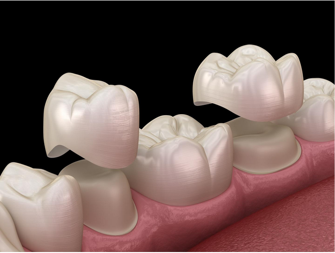 Làm răng sứ sẽ ảnh hưởng răng thật như thế nào