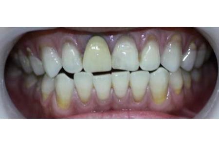  Răng sứ bị đen phải làm sao - Tìm hiểu các giải pháp làm trắng răng