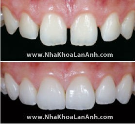 Hình: Hình trước và sau khi phục hình Veneer cho trường hợp răng cửa bị thưa