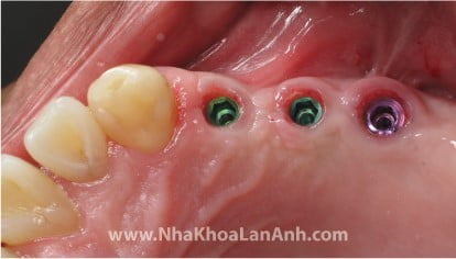 hinh: implant dat o vung nhieu xuong, duoc xuong bao phu xung quanh se it sung, dau sau phau thuat.