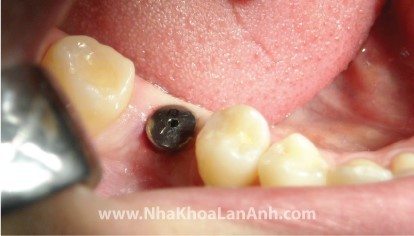 rang-duoc-trong rang-implant. trồng răng