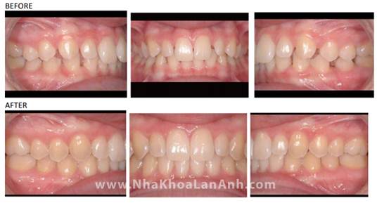 Hình: Invisalign có chỉ định rất tốt với các trường hợp rang thưa, do khay ôm trọn bề mặt răng và di chuyển rất chính xác. Thời gian điều trị cho trường hợp răng thưa của Invisalign cũng nhanh hơn đáng kể so với mắc cài. Thông thường chỉ khoảng 4-7 tháng.