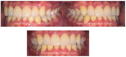 Hình sau khi điều trị niềng răng không mắc cài Invisalign, có kết hợp Veneer sứ để cải thiện hình dạng răng.