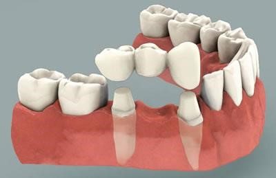  Khi bọc răng sứ phải bỏ đi đôi cùi răng khoẻ mạnh cũng là nhược điểm của cầu răng sứ 